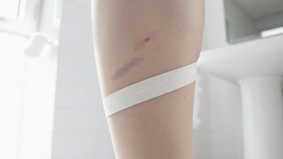 Jak długo mogą utrzymywać się krwiaki podskórne?